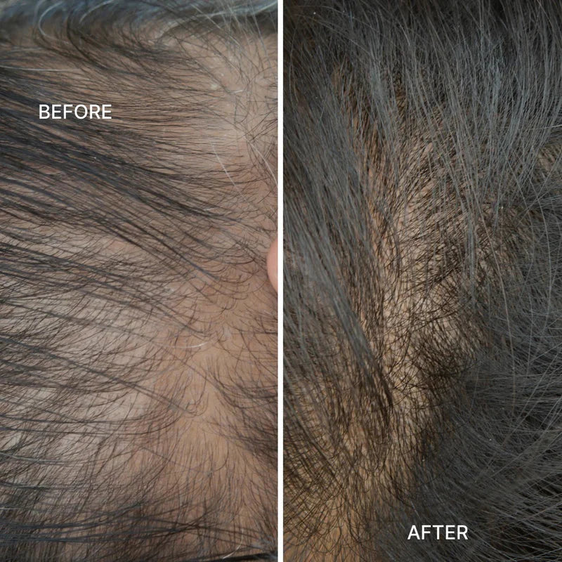 Red Light Therapy Scalp Massager